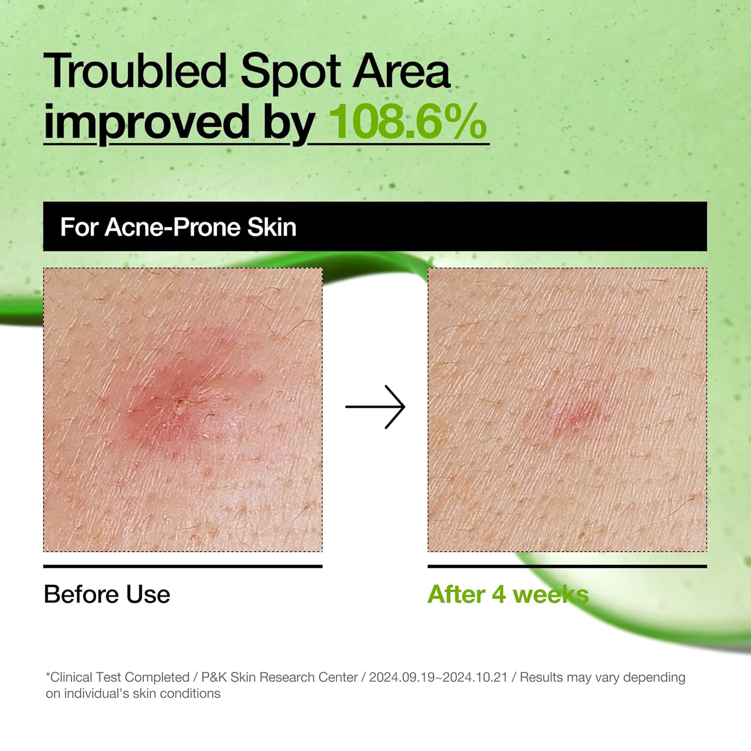 Anua | Azelaic Acid Serum